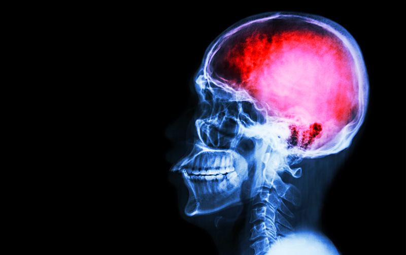 Concussion